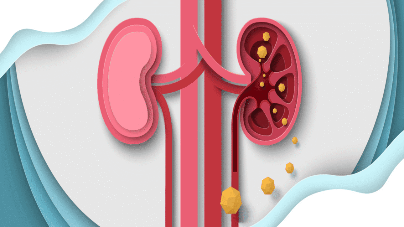 Kidney stone treatment Chennai